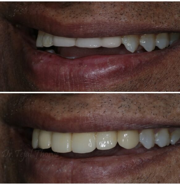 full mouth rehab smile desgining best dental clinic in dombivli east