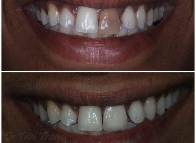 metal free ceramic crown smile desgining best dental clinic in dombivli east
