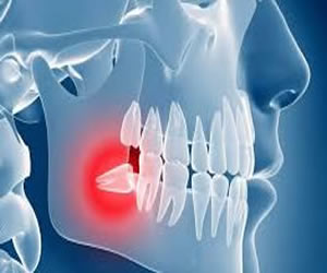 wisdom tooth extraction