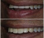 full mouth rehab smile desgining best dental clinic in dombivli east