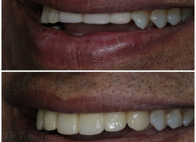 full mouth rehab smile desgining best dental clinic in dombivli east