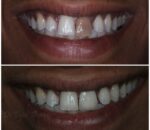 metal free ceramic crown smile desgining best dental clinic in dombivli east