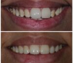 metal free crown 2 best dental clinic in dombivli east