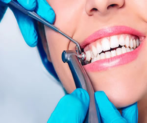 teeth cleaning & polishing